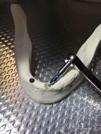 Implantate setzen