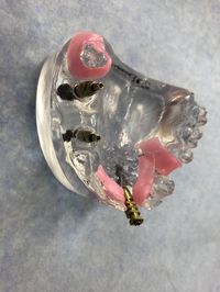Implantatprothetik