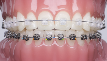 Damon-Spange mit zahnfarbenen Brackets 
